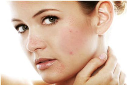 Causes of Acne and Home Remedies