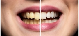 How to prevent tooth discoloration