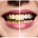How to prevent tooth discoloration
