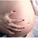 Side Effects of Tummy Tuck on the Future Pregnancy